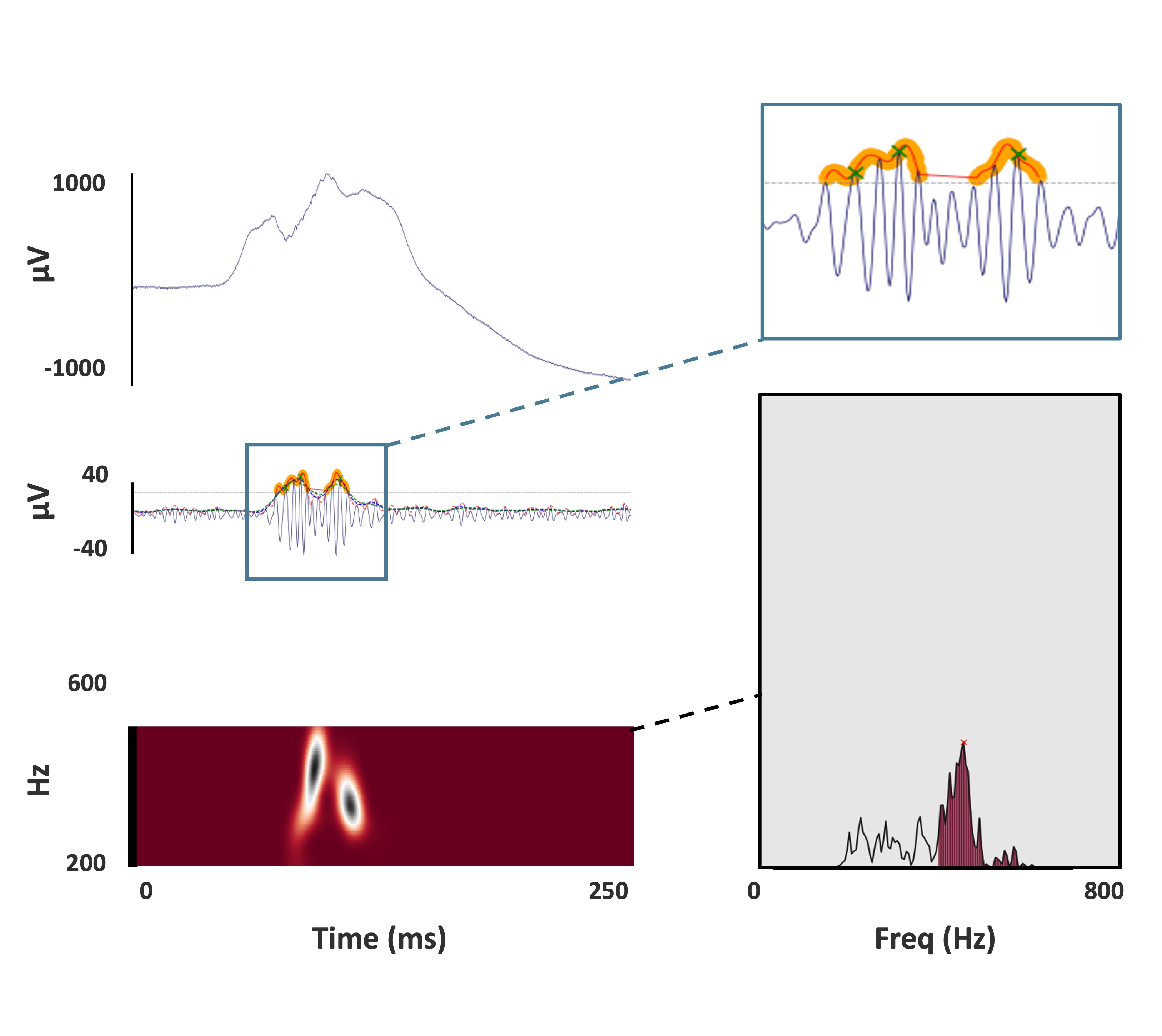 Détection IA de biomarqueurs - Guidage chirurgical en épilepsie