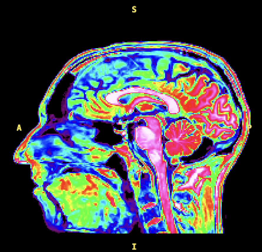 Neuropsychiatrie - Corrélations structure cérébrale et symptômes